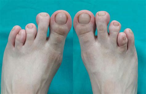 4 ayak parmağı kısalığı